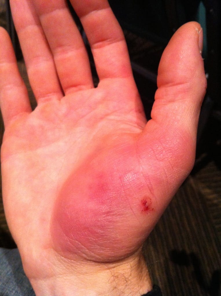 nail-gun-injury-the-craftsman-blog